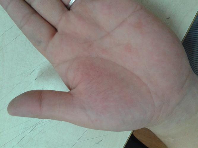 以前有人说过这是湿疹,对么?详细见照片,求专业处方?谢谢!