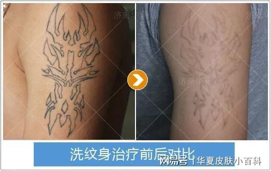 常识科普激光洗纹身对皮肤有伤害吗