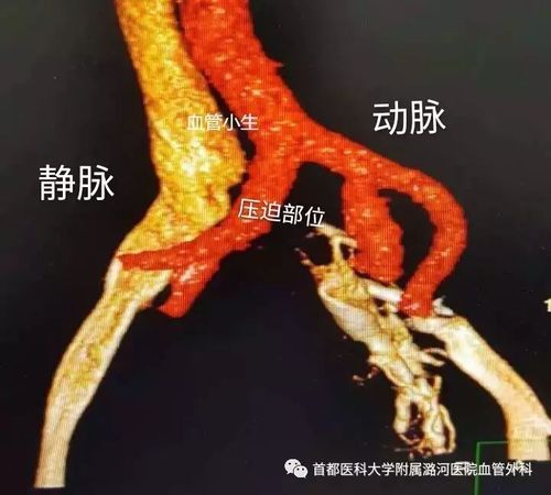 髂静脉压迫综合征,不容忽视的"小问题"