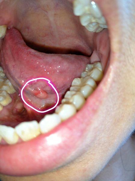 请问一下我这个是不是舌下腺囊肿?