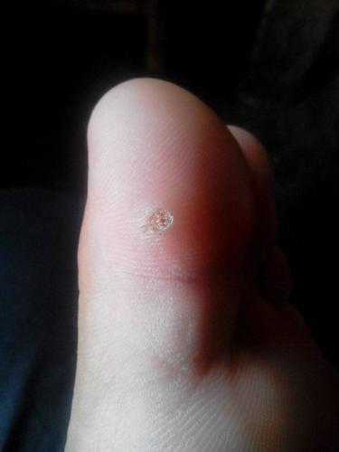 问:大家帮我看看这是不是鸡眼,里面有黑黑的肉刺,可以的话告诉我,病名