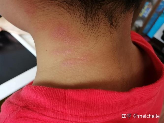 娃脖子上起了一片片红的包不知道是啥