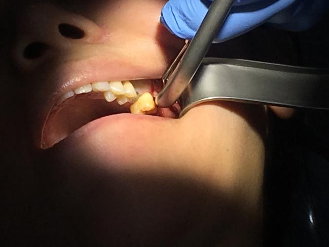 一例智齿拔除病例