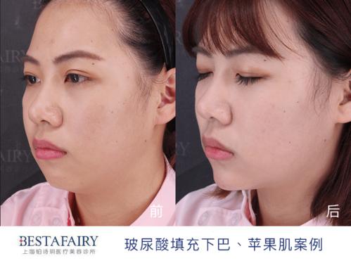 可以通过注射玻尿酸进行调整面部轮廓,建议下巴注射2支玻尿酸,苹果肌1