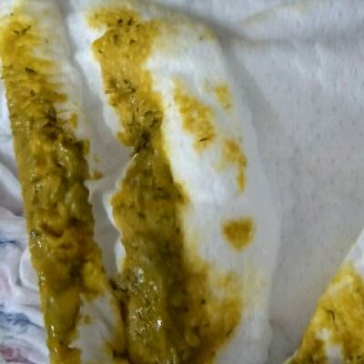 宝宝六个月刚添辅食,拉粑粑里面有黑色的像小虫子的东西是为什么?