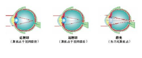 如何区别老年性散光和老花眼