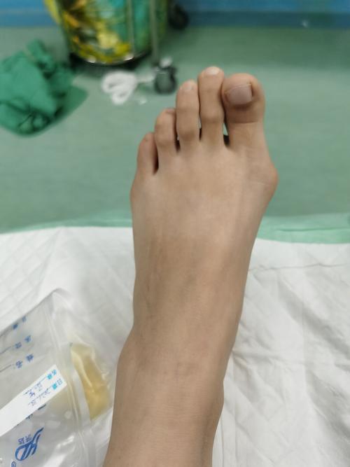 乔某足拇外翻