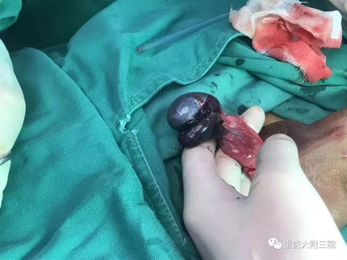 附三院健康科普蛋疼不是小事警惕睾丸扭转