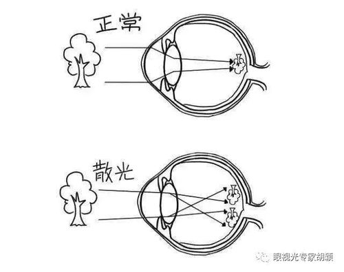 散光到底需不需要配镜?