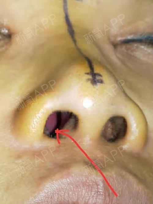 鼻腔下鼻甲肥大2度