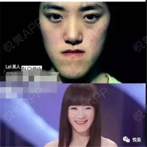 但地包天也分为牙性和骨性