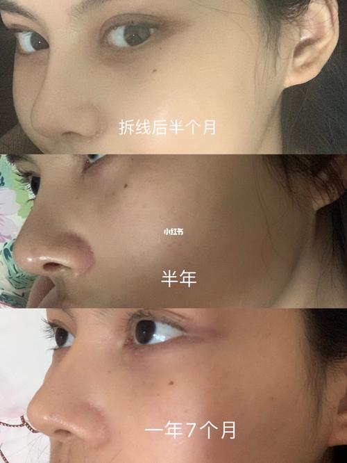 切鼻翼,切肋骨恢复后反馈,疤痕增生_疤痕_发炎_韩剧_切鼻翼_美妆_医美