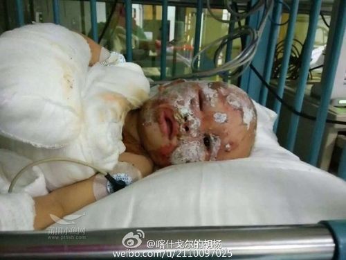揪心一岁小孩不小心扯下煤气灶整个脸被重度烧伤