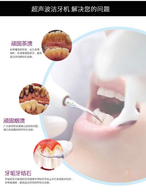 牙垢清除器 洗牙器超声波洁牙机牙结石去除器烟渍牙垢清除工具无水