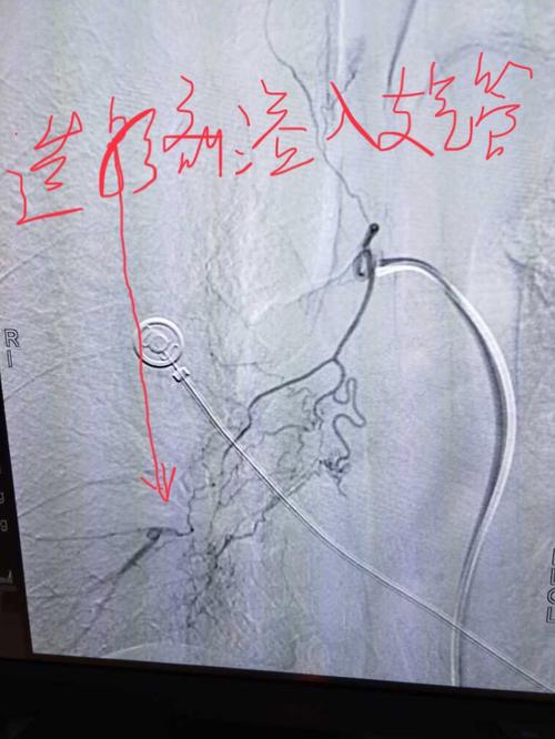 右支气管动脉造影见右肺下叶支气管动脉,扭曲,且造影剂直接溢入支气管