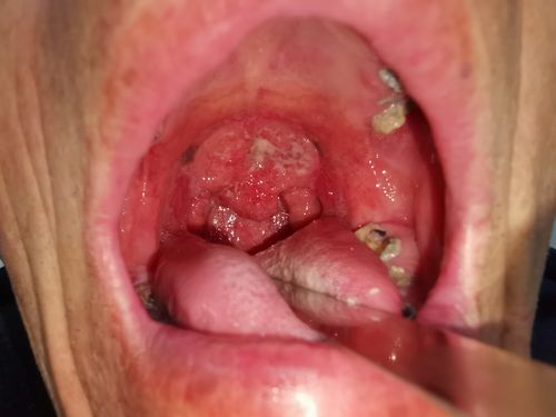 术前病灶情况,全软腭至两侧咽侧壁可见菜花样肿物.