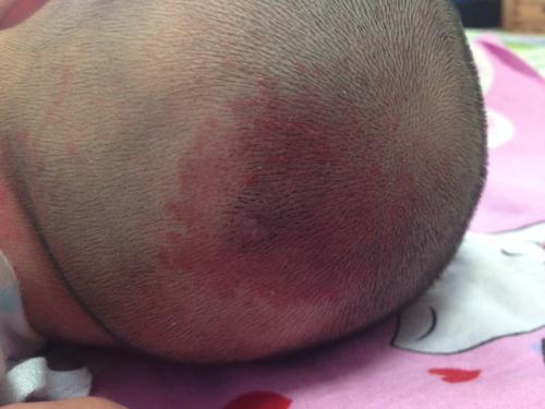 问:请问这是新生儿斑痣吗 会自行消退吗?妈妈好担心