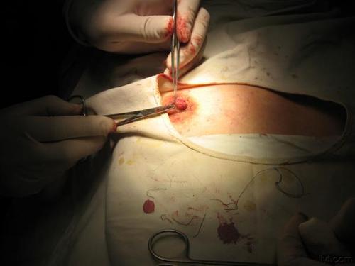 "乳头凹陷"治疗