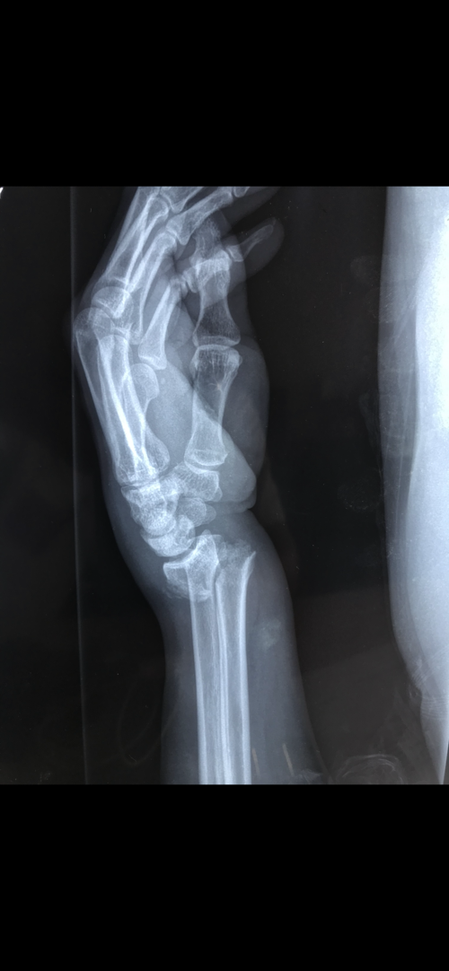 左桡骨远端骨折伴尺骨茎突骨折手术一例