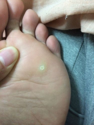 脚下长了一个硬硬的东西