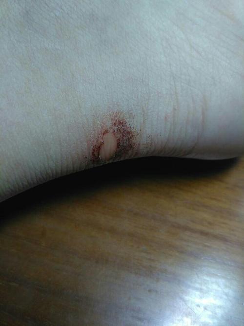 脚后跟的皮磨破了怎么办?