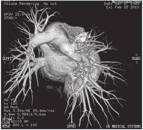肺动脉段明显突出就是肺动脉高压吗