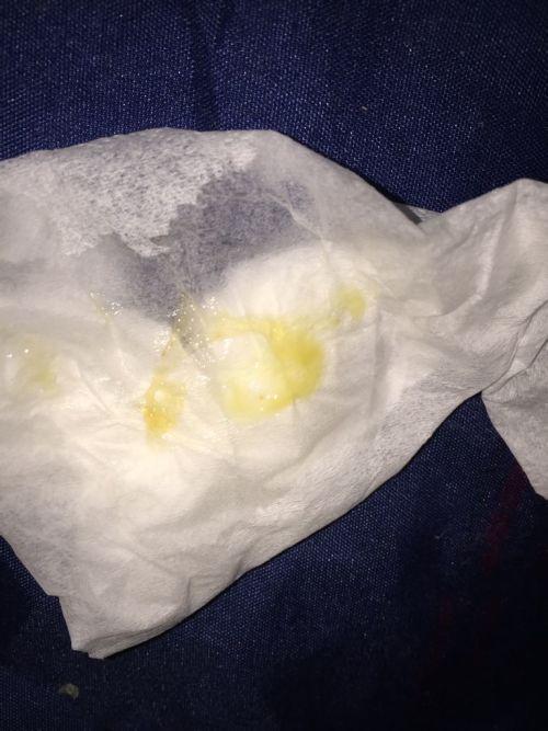 连续两天早上起来就有一口浓痰,仔细看好像有点血,不咳嗽.