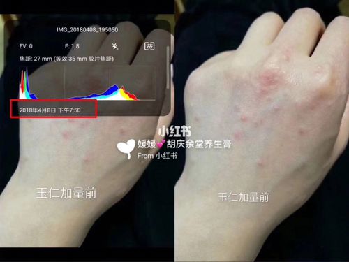 湿疹,中医称为"湿毒疮"或"湿气疮"所谓"毒",是指一些热毒,令身体产生