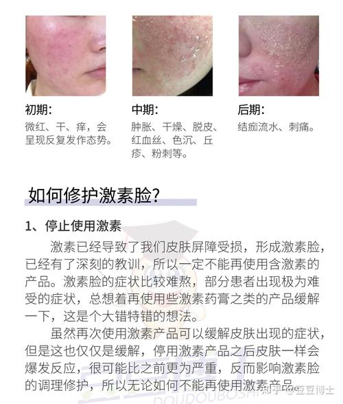 关于激素脸你一定有很多疑问