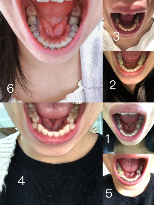 我在澳洲正畸治疗-下牙弓扩弓器_牙齿矫正_我在澳洲_正畸_美妆_医美