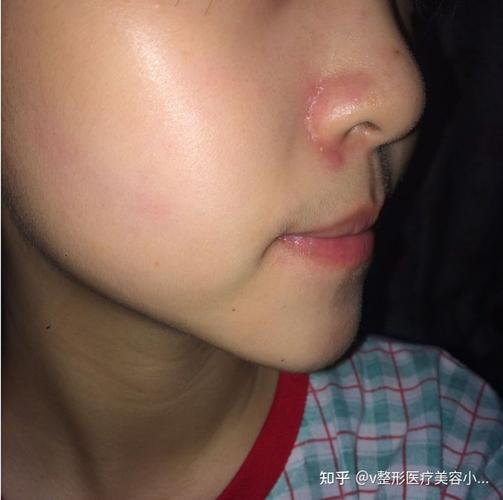 不要过于恐慌,但是也不能不当回事,这个有可能是 溢脂性皮炎