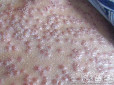 湿疹的病因,湿疹有哪些原因