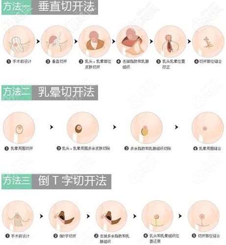 不知道哪种缩胸术疤痕小?