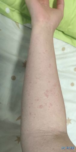吃完龙虾就过敏了,全身大面积红斑疙瘩,从头皮到脚面奇痒无比
