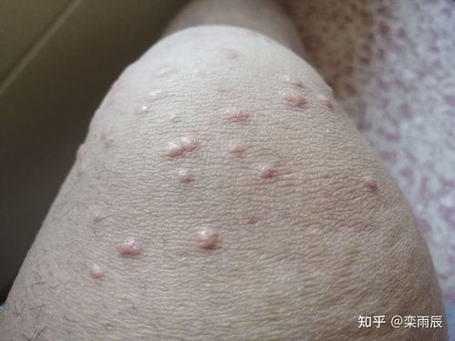 腿上的疱疹,医生说是糖尿病并发症