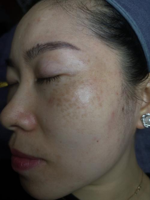 3.5真皮斑黄褐斑