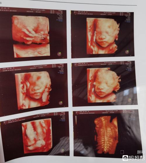 今天照了四维医生说鼻骨未见为娘很是担
