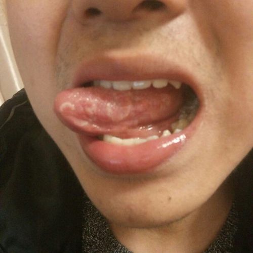 舌头上的白色条状物体是什么 有了很久了