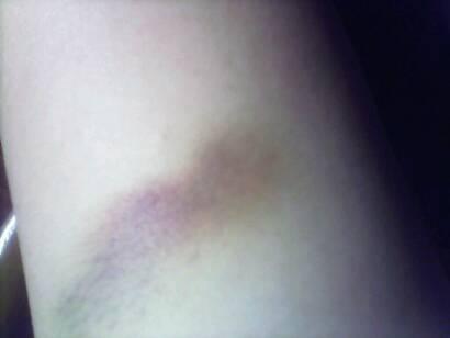 手臂青紫,不疼,怎么回事?