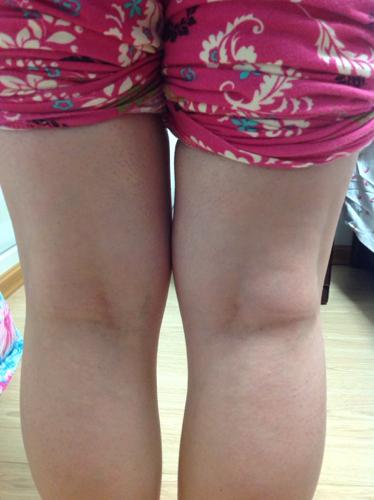 右膝盖后面疼,肿大,怎么回事?帮一下忙