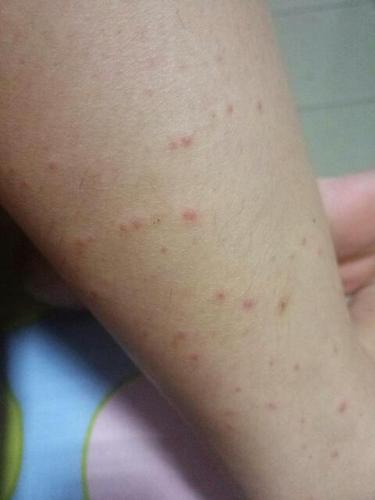 腿上长了好多红疹怎么办,不痛不痒,没有任何感觉