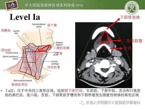 【2018住培系列讲座 第45期】颈部淋巴结的影像解剖及
