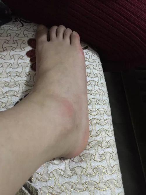 浅谈崴脚那些事