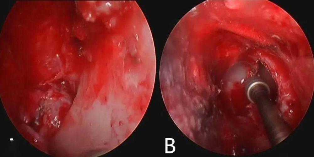 a:咬除鼻中隔后暴露蝶窦前壁;b:磨钻磨除蝶窦前壁及蝶窦腔骨性分隔.