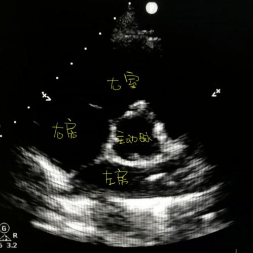 图文详解 | 心超切面不会打?看这一篇就够了!_心尖
