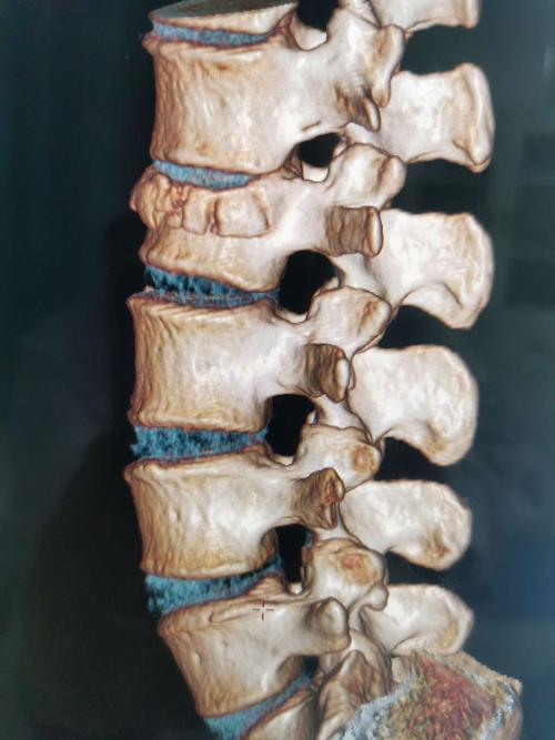 腰2椎体压缩性骨折,闭合复位微创经皮钉棒系统内固定手术治疗.
