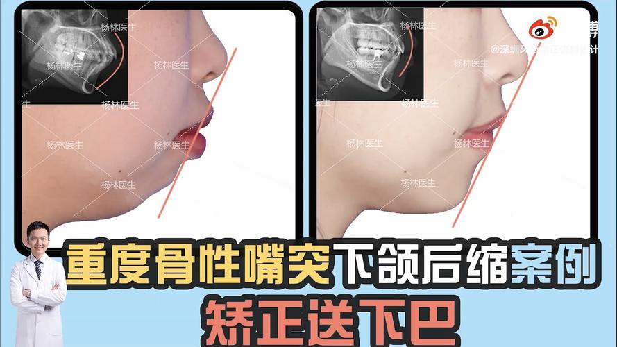 让你们看看什么是牙齿矫正,整一送一,拔牙送下巴!