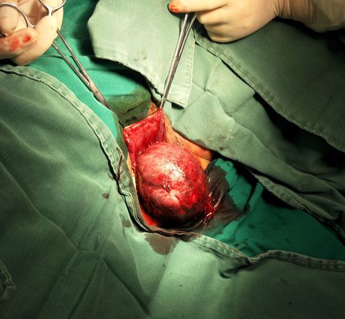 我老婆就要生了,孩子的头都露出来了