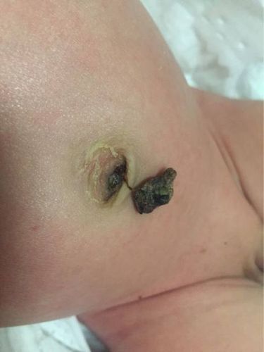 小孩肚脐发炎图片