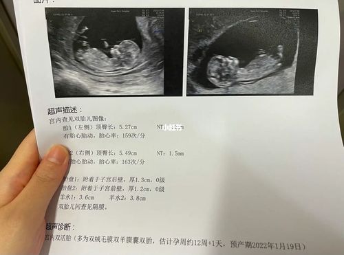 nt两个宝宝还是蛮配合的～萌萌哒_nt检查_nt检查_母婴